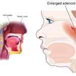 Adenoidid